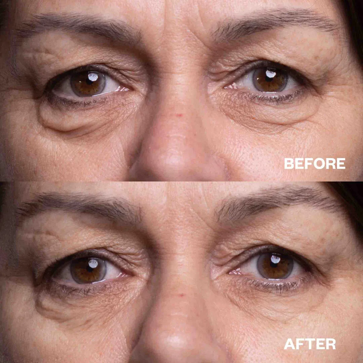 Eye Wrinkle Patches